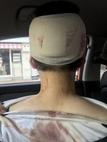 '이수역 폭행 사건'으로 다쳤다는 한 여성이 포털사이트 네이트판에 "뼈가 보일 만큼 폭행당해 입원 중이나 피의자 신분이 됐다"며 올린 사진.   [네이트판 캡처]